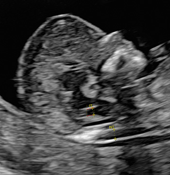 Ultraschalluntersuchung, Screening, Kopf von Baby