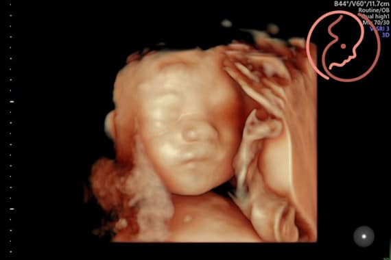 3D-/4D-Ultraschall – Bilder von Ihrem Kind